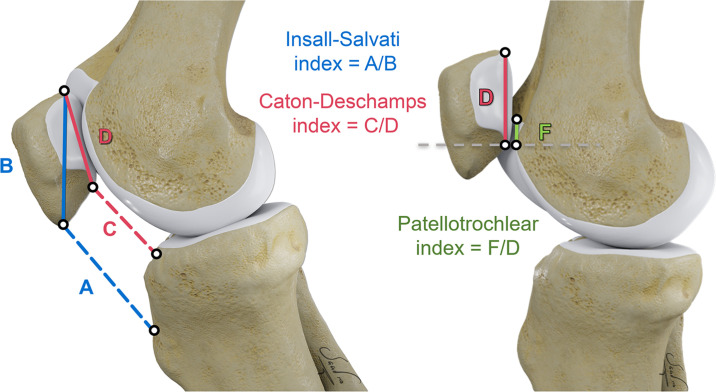 Measurements for patellar height. The patellar tendon length at its inner aspect (A), greatest diagonal length of the patella (B), distance between the inferior margin of the patellar articular surface and anterior lip of the tibial plateau (C), greatest length of the patellar articular surface (D), and length of trochlear cartilage overlapping the patella (F) are depicted.