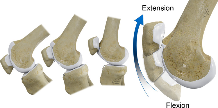 Normal patellofemoral kinematics. As the knee flexes and extends, the patella tilts, rotates, and shifts with respect to the trochlea, incorporating six degrees of freedom of patellar movement. Measurements of patellar height vary at different degrees of knee flexion and can confound evaluation of the patella alta. Standard lateral radiographs used to define the normal range of patellar height are obtained at 30° of flexion. Standard CT and MR images are obtained with the knee in extension; therefore, the patella is normally positioned more proximally relative to the trochlea.