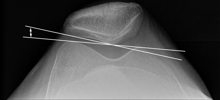 Lateral patellofemoral angle. The lateral patellofemoral angle (double-headed arrow) is measured between the line drawn along the lateral patellar facet and the line from the medial to lateral margins of the trochlea.