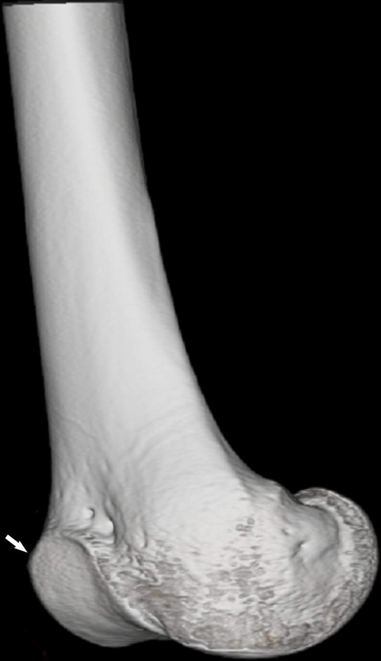 Trochlear dysplasia. 3D CT reconstruction of the distal femur shows a flat trochlea (arrow) with an anterior prominence in relation to the distal femur.