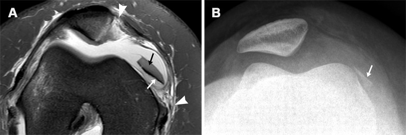 Osteochondral injury of the inferior medial aspect of the patella in a 19-year-old woman after an acute patellar dislocation. (A) Axial proton-density–weighted fat-suppressed MR image shows tearing of the MPFL at the patellar and femoral attachments (arrowheads). An additional sheared intra-articular osteochondral fragment composed of a slab of articular cartilage (black arrow) and a sliver of subchondral bone plate (white arrow) is seen. (B) The presence of an osseous component makes the fragment (arrow) visible on a sunrise-view radiograph.