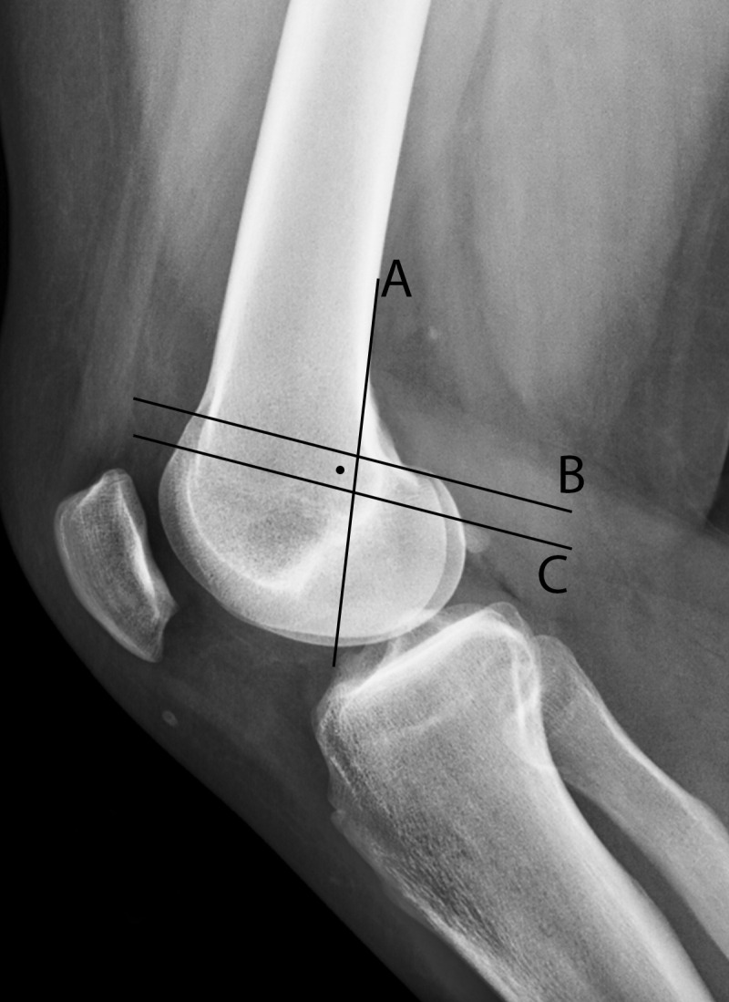 Radiographic landmarks for MPFL reconstruction. The Schöttle point (dot) is the midpoint of the MPFL attachment on the femur and the target for MPFL reconstruction tunnel placement (16). Lateral radiograph shows that the Schöttle point is 1 mm anterior to the posterior cortex extension line (A), distal to a line drawn between the anterior and posterior origins of the medial femoral condyle (B), and proximal to the level of the posterior point of the Blumensaat line (C).