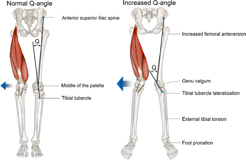 Quadriceps angle, or Q angle. This angle is formed by the intersection of lines drawn from the anterior superior iliac spine to the center of the patella, and from the center of the patella to the tibial tubercle. An increased Q angle is associated with an increased magnitude of laterally directed forces on the patella (blue arrows) and thus increases the risk of lateral patellar maltracking and dislocation. Femoral anteversion, genu valgum, tibial tubercle lateralization, external tibial torsion, and foot pronation can contribute to an increased Q angle.