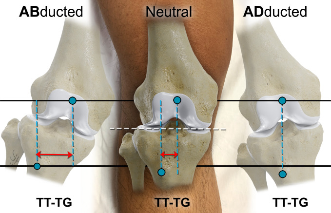 Effect of axial image orientation on the TT-TG measurement. The TT-TG (double-headed arrows) is sensitive to small changes in knee position and should be interpreted with caution if the orientation of the axial image acquisition is not standardized. For neutral orientation and accurate measurement, the axial imaging plane (black lines) is prescribed along the anatomic axial plane parallel to the knee joint (white dashed line). Abduction results in a significant increase in TT−TG, while adduction leads to a spurious decrease in TT−TG.