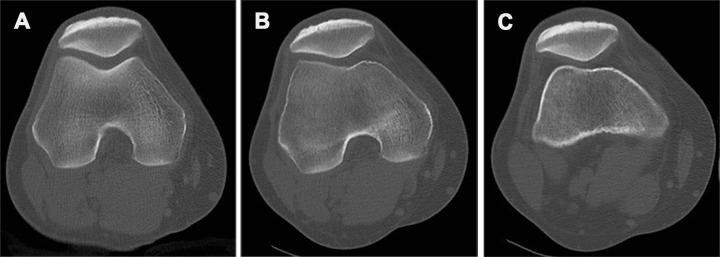 CT assessment for the J sign. Axial CT images at the level of the mid patella show the dynamic relationship of the patella with the trochlea in 30° of flexion (A), 0° of flexion (B), and slight hyperextension (C). Obtaining images at different positions from flexion to extension allows characterization of trochlear engagement and quantitative evaluation of the superior and lateral translations of the patella in extension.