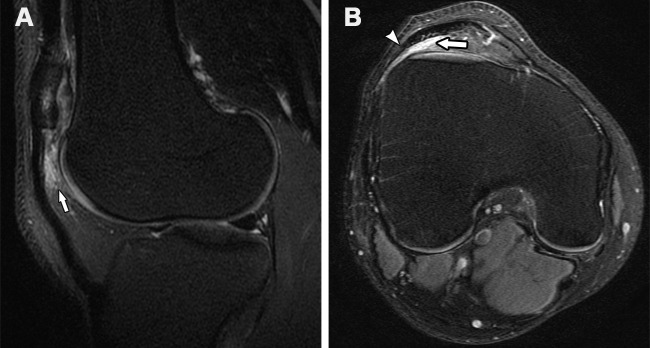 Anterior knee pain and instability in a 21-year-old man. Sagittal T2-weighted (A) and axial proton-density–weighted (B) fat-suppressed MR images show lateral maltracking of the patella and patellar tendon, with the lateral aspect of the patellar tendon (arrowhead in B) extending laterally to the lateral trochlear ridge. There is also subjacent ill-defined edema (arrow) within the superolateral aspect of the infrapatellar fat pad, consistent with fat pad impingement.