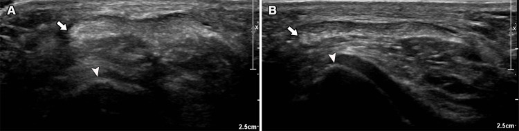 Sonographic assessment of patellar instability. Transverse US images of the patellar tendon can be used to quantify lateral translation at various degrees of flexion without (A) and with (B) quadriceps contraction. The distance from the lateral edge of the patellar tendon (arrow) in relation to the lateral margin of the trochlea (arrowhead) can be readily measured and indicates an increase in patellar tendon overriding with quadriceps contraction that is characteristic of maltracking.