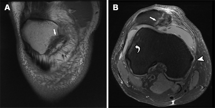 Recurrent patellar dislocation in a 34-year-old man after a fall while walking. Coronal T1-weighted (A) and axial proton-density–weighted fat-suppressed (B) MR images show an inferomedial patellar fracture (straight arrow) associated with bone marrow edema-like signal intensity. An MPFL tear (arrowhead in B) at the femoral attachment and a characteristic bone contusion (curved arrow in B) at the lateral aspect of the lateral femoral condyle also are present.