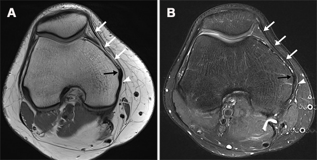 MPFL. Axial proton-density–weighted (A) and T2-weighted fat-suppressed (B) MR images show a normal MPFL (white arrows). The MPFL is a horizontally oriented ribbonlike ligament that spans from the medial patella to the adjacent medial femur. The MPFL merges with the fibers of the medial collateral ligament (black arrow) at the epicondyle and inserts immediately posterior onto the femur (arrowhead).