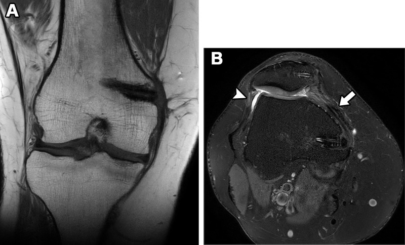 Postoperative findings in a 25-year-old woman after MPFL reconstruction and lateral release. Coronal T1-weighted (A) and axial proton-density-weighted fat-suppressed (B) MR images show the expected finding of an intact MPFL reconstruction with a semitendinosus allograft (arrow in B) and bioabsorbable screw tracts at the medial patella and near the medial femoral epicondyle. Expected postprocedural changes, with attenuation of the lateral retinaculum from a prior lateral release (arrowhead in B), also are seen.