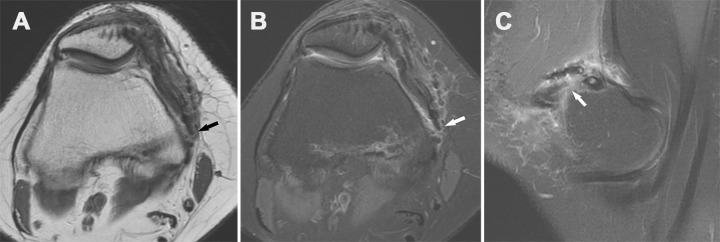 Recurrent patellar dislocation in a 29-year-old woman 3 years after she underwent MPFL reconstruction. Axial proton-density–weighted (A) and T2-weighted (B) fat-suppressed MR images and sagittal T2-weighted fat-suppressed MR image (C) show tearing of the femoral attachment site of the reconstructed MPFL (arrow), near the femoral interference screw.