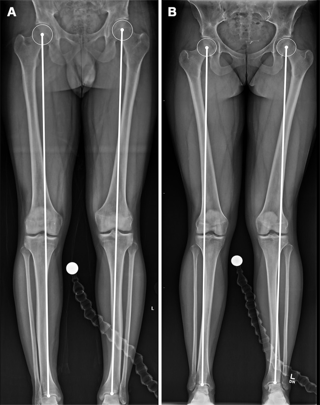 Evaluation of the mechanical axis on radiographs in a 27-year-old man with a normal mechanical axis (A) and a 31-year-old woman with bilateral genu valgum (B). The mechanical axis is evaluated on standing full-length lower extremity radiographs. A line is drawn from the center of the femoral head to the center of the talar dome. A normal mechanical axis is defined by a line passing through the knee between the medial and lateral margins of the tibial spine.