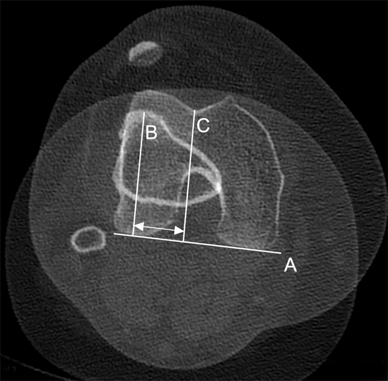 Measurement of tibial tubercle lateralization. Postreconstruction analysis can be used to make a more accurate determination of the TT-TG (arrows). Superimposing an axial CT section through the tibial tubercle (B) on top of a section at the posterior femoral condylar reference line (A) and the deepest point of the trochlear groove (C) allows a more reliable calculation of the TT-TG.