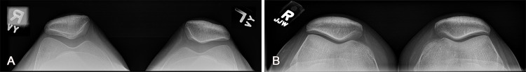 Imaging evaluation of patellar dislocation. (A) Merchant-view radiographs, which are obtained with the patient supine, the knee flexed to 45° at the table edge, and the tube angled downward 30°, typically with both knees in the field of view, enable evaluation of patellar alignment and symmetry. (B) Sunrise-view radiographs may be obtained with the patient prone (shown here) or supine, but for prone radiographs, they are obtained with the knee flexed to 115° and the tube angle 15° cephalad. The sunrise view is not as sensitive for assessment of patellar maltracking, but it allows better visualization of the inferior patellofemoral joint.