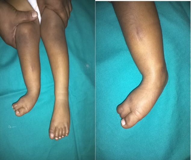 FATCO Syndrome Variant - Fibular Hypoplasia, Tibial Campomelia and ...