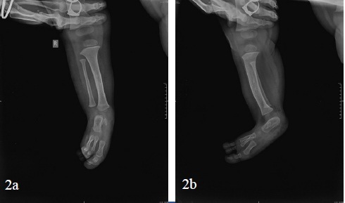 FATCO Syndrome Variant - Fibular Hypoplasia, Tibial Campomelia and ...