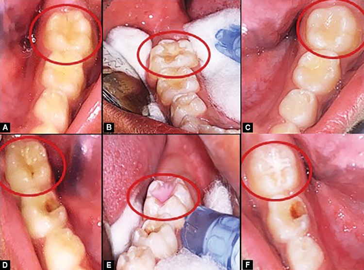 Figs 1A to F