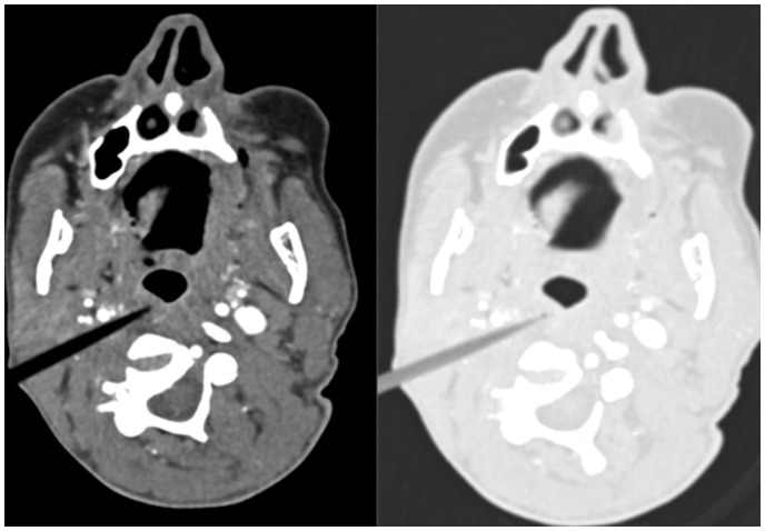 An Approach To Accurate Computed Tomography Imaging Interpretation In 