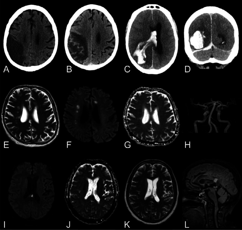 Macrovascular and diffusion imaging findings. First row (A, B): Man in his late 60s with COVID-19, left side motor symptoms and left-sided ophthalmoplegia upon a routine wake up test from anesthesia. A, Non-enhanced brain CT in the axial view demonstrating an infarct of the right middle cerebral artery territory. B, Axial non-enhanced brain CT in the axial view a week later revealed hemorrhagic transformation. First row (C, D): Man in his mid-50s with COVID-19 a month after symptom onset and several weeks in the ICU. Non-enhanced brain CT in the, C, axial and, D, coronal views. Intracerebral hematoma dissecting into the ventricles and along the right tentorium. Low attenuation in the territories of right middle and posterior cerebral arteries were also found. Second row: Man in his mid-50s with COVID-19 after a month in the ICU and impaired consciousness (GCS 3) after termination of anesthesia. Brain MRI with, E, axial T2-weighted imaging, F, b1000 DWI,and, G, ADC map showing multiple, bilateral acute lacunar infarcts in the semioval centers. H, TOF MRA with normal findings. Third row: Woman in her late 40s with COVID-19, impaired consciousness and paretic extremities 2 weeks after admission to the ICU. Brain MRI with, I, axial b1000 DWI, J, ADC map, K, T2-weighted imaging, and, L, sagittal T2-weighted FLAIR showed a cytotoxic lesion of the corpus callosum in the splenium. ADC = apparent diffusion coefficient, DWI = diffusion weighted imaging, FLAIR = fluid-attenuated inversion recovery, GCS = Glasgow coma scale, ICU = intensive care unit, SWI = susceptibility-weighted imaging, TOF MRA = time-of-flight magnetic resonance angiography.