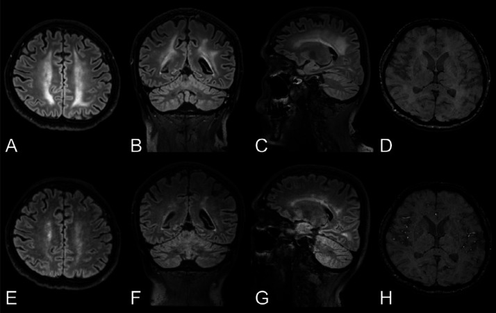 Longitudinal changes in white matter signal abnormalities. Top row: Man in his mid 40s with COVID-19 and confusion a month after symptom onset and 2 weeks in the ICU. A-C, Baseline brain MRI with non-enhanced T2-weighted FLAIR images in the axial, coronal, and sagittal views exhibit symmetric confluent white matter changes bilaterally. D, Axial SWI also revealed a few susceptibility abnormalities in the splenium of corpus callosum. There was no reduced diffusion (images not shown). EEG performed 3 days prior to the MRI, found signs of encephalopathy. Bottom row: E-G, Follow-up brain MRI a week later with non-enhanced T2-weighted FLAIR images in the same views demonstrating partial resolution of the leukoencephalopathy, correlating with an improved mental state. H, The extent of susceptibility abnormalities in the brain parenchyma was unchanged. FLAIR = fluid-attenuated inversion recovery, ICU = intensive care unit, SWI = susceptibility-weighted imaging.