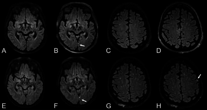 Progressive leptomeningeal enhancement. Top row: Woman in her late 60s with COVID-19 with impaired consciousness after termination of anesthesia. Baseline brain MRI with, A, pre- and, B, post-contrast T2-weighted FLAIR images in the axial view revealing a solitary focus of leptomeningeal enhancement (arrow) along the medial aspect of the left occipital lobe. Bottom row: Follow-up 3.5 weeks later. The original leptomeningeal enhancement focus had increased slightly (E, F with arrow). A new focus of leptomeningeal enhancement had formed along the left inferior frontal gyrus (G, H with arrow) not present on the baseline scan (C, D). FLAIR = fluid-attenuated inversion recovery, ICU = intensive care unit.