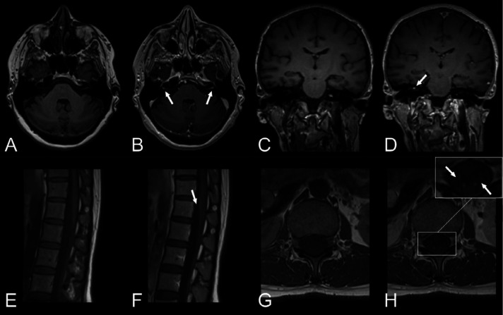 Cranial nerve and spinal nerve root enhancement. First row (A, B): Woman in her early 60s with COVID-19, bilateral leg weakness and paresthesias. Brain MRI with T1-weighted images, A, pre- and, B, post-contrast in the axial view showing focal contrast enhancement of the canalicular segment of facial nerve bilaterally. Lumbar puncture showed elevated albumin with no cells and nerve conduction studies were consistent with acute demyelinating polyneuropathy. She received intravenous immunoglobulin treatment on suspicion of Guillain-Barré syndrome and improved clinically. First row (C, D): Woman in her mid 40s with COVID-19 and typical findings of right-sided vestibular neuronitis. Brain MRI with T1-weighted images, C, pre- and, D, post-contrast in the coronal view depicting focal enhancement of the right vestibular nerve. Second row: Woman in her mid 30s with COVID-19, pain in the lumbar region and paresthesias in the lower extremities. Lumbar spinal MRI with T1-weighted images, E, pre- and, F, post-contrast in the sagittal view revealed faint contrast enhancement along the cauda equina. T1-weighted images, G, pre- and, H, post-contrast in the axial view verified contrast enhancement of the nerve roots.