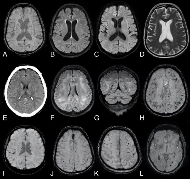 SWI abnormalities. First row: Man in his mid 60s with COVID-19, tetraplegia and prolonged confusion (GCS14) after extubation. Brain MRI with, A, axial SWI reveals numerous cerebral susceptibility abnormalities bilaterally in the white matter, most prominently in the corpus callosum and especially in the splenium, many of which have an ovoid shape (as further exemplified in Figure E3). B, Axial T2-weighted FLAIR, C, b1000 DWI, and, D, T2-weighted imaging without any remarkable findings. Second row: Man in his early 60s with COVID-19 and impaired consciousness (GCS 2+T+1) a week after termination of anesthesia. E, Non-enhanced brain CT in the axial view initially reported as normal. Brain MRI the following day with T2-weighted FLAIR images in the, F, axial and, G, coronal views showing subcortical extension of leukoencephalopathy without associated reduced diffusion (images not shown). H, Axial SWI reveals extensive susceptibility abnormalities with a predilection for subcortical U-fibers, corticospinal tracts, and the corpus callosum. Third row: Four other patients with COVID-19. Brain MRI with SWI in the axial view showing different degrees and types of susceptibility changes. A few susceptibility abnormalities in the splenium and genu of corpus callosum (I, man in his mid 60s), numerous subcortical cerebral susceptibility artifacts (J, man in his mid 60s), subarachnoid hemorrhage and cortical superficial siderosis (K, man in his late 50s) and dependent intraventricular blood in the posterior horns of the lateral ventricles (L, woman in her mid 40s).