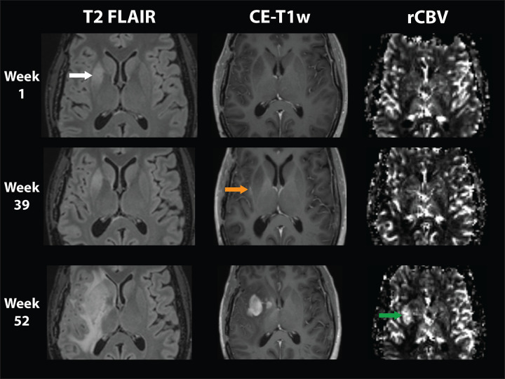 Brain Tumor Imaging without Gadolinium-based Contrast Agents: Feasible ...