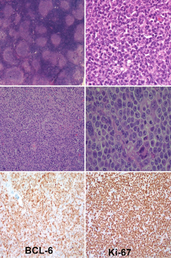 Double-hit and triple-hit lymphomas arising from follicular lymphoma ...