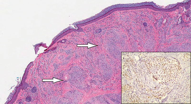 Cellular Neurothekeoma: A Rare Tumor with a Common Clinical ...