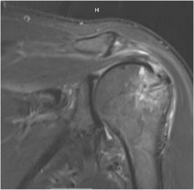 Rates Of Medial And Lateral Row Failure And Risk Factors For Re Tear In Arthroscopic Double Row