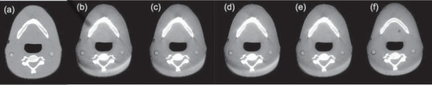 Cone Beam CT vs. Fan Beam CT: A Comparison of Image Quality and Dose ...