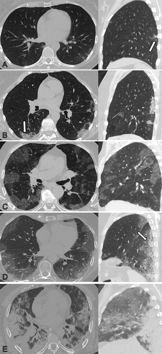 Unenhanced axial (left) and sagittal (right) chest CT scans corresponding to CT severity score. (A) Score of 1: minimal (subtle ground-glass opacities [GGOs], few findings). Scans show subtle subpleural GGO (arrow) in the right and left lower lobes. (B) Score of 2: low (several GGOs, subtle reticulation). Scans show several subpleural GGOs and superimposed reticulation (arrow) in the right and left lower lobes and the left upper lobe. (C) Score of 3: moderate (multiple GGOs, reticulation, small consolidation). Scans show multiple GGOs in all lobes. (D) Score of 4: marked (extensive GGOs, consolidation, reticulation with distortion). Scans show extensive subpleural GGOs and consolidations (arrow) in the dependent lung. (E) Score of 5: massive (massive findings, parenchymal destructions). Scans show massive consolidations in the dependent lung areas, as well as extensive GGOs in the upper lobes. (Parenchymal destruction includes pneumatocele, cavitation, or abscess formation.)