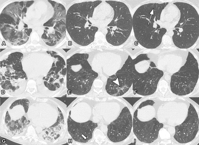 Serial unenhanced axial chest CT scans in three study participants with previous COVID-19 pneumonia. (A–C) Scans in a 44-year-old man. During acute COVID-19, scan shows extensive bilateral ground-glass opacities (GGOs) and subpleural reticulation (A). At 2-month follow-up, almost complete resolution of GGOs with residual subpleural reticulation in the middle lobe is noted (B). These subpleural reticulations (arrow) persisted up to 1 year after onset (C). (D–F) Scans in a 68-year-old-man. During active infection, scan shows patchy bilateral consolidations, a subpleural arcadelike sign, and pleural effusions (D). At 2-month follow-up, a substantial improvement in organizing pneumonia pattern is seen, with GGO and subpleural reticulation, including arcadelike sign (arrowhead) in the left lower lobe (E). At 1-year follow-up, further improvement is seen, but subtle reticulation and GGO can still be detected (F). (G–I) Scans in a 79-year-old man. During admission to intensive care unit, scan shows bilateral consolidations and small areas of GGO (G). At 2-month follow-up, residual GGO and small subpleural microcystic changes (arrow) are seen (H), and persisted up to 1 year after onset (I).