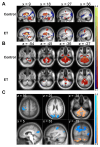 ET and control motor thalamus functional connectivity differences
