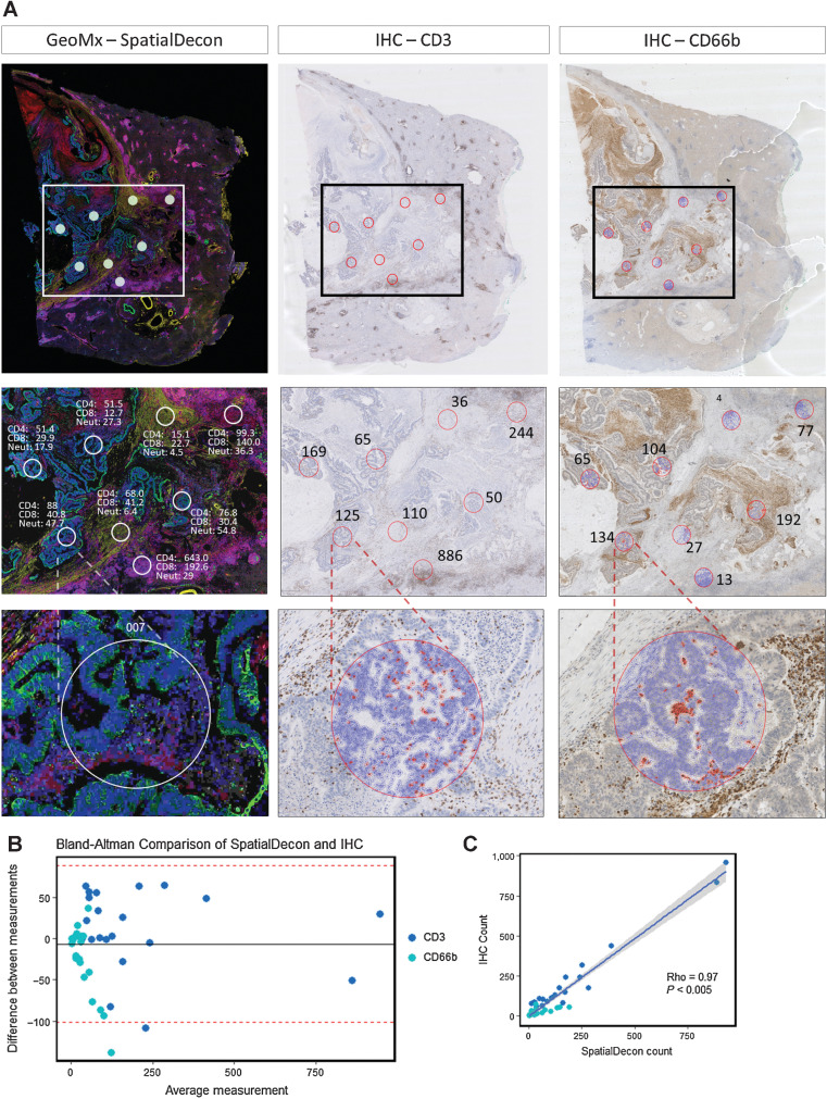 Figure 5. Immune cell spatial deconvolution. A, Representative images from 1 CRLM (Patient A, Fig. 4A) showing cell detection from the Qupath package used on a CD3 and CD66b IHC-stained liver metastasis to count number of CD3 and CD66b-positive cells from 21 regions from a total of 3 CRLM. This count was compared with the SpatialDecon-derived count that uses the transcriptomic data from the corresponding ROI in the GeoMx mIF-stained matched sample (See Supplementary Fig. S5). B, Bland Altman plot comparing transcriptome SpatialDecon-derived cell count versus the IHC-derived cell count. C, Correlation plot comparing transcriptome SpatialDecon-derived cell count versus the IHC-derived cell count.