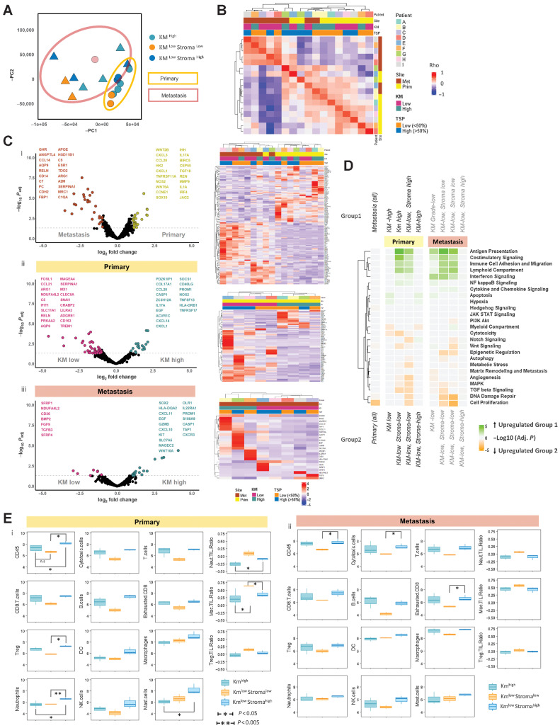 Figure 2. BULK IO360 transcriptomic characterization of matched primary colorectal cancer and CRLM. A, PCA plot demonstrating 2 principal components of minimal variance for all samples. Primary colorectal cancer samples are demonstrated by circles and yellow outline. CRLM are demonstrated by triangular points and brown outline. KMhigh, KMlow Stromalow and KMlow Stromahigh samples are depicted by color. B, Unsupervised analysis using gene expression correlation matrix for all samples. Patient, site, KM grade, tumor stromal percentage (TSP) are depicted by key. Spearman correlation of all expressed genes performed between each sample sequenced and plotted on the heatmap. k-means clustering of heatmap to demonstrate correlated samples. Red represents strong correlation. Blue represents negative correlation. C, Volcano plots demonstrating differential gene expression results and clustered heatmap of significant genes for (i) all primary colorectal cancer versus CRLM; (ii) KM grade: KM high versus KM low primary colorectal cancer; (iii) KM grade: KM high versus KM low CRLM. The x-axis of volcano plot demonstrates log2fold change, y-axis demonstrates –log10P. Colored points demonstrate significant changes in gene expression between groups (P < 0.05 and logFC>1.5). Volcano plots demonstrate top 20 differentially expressed genes for each group. D, Heatmap demonstrating Gene Set Enrichment Analysis (GSEA) results comparing the different tumors grouped according with KM grade and TSP using io360-curated gene sets annotated on the right of the diagram. Heatmap squares represent Log10 Adjusted P value. Green demonstrates upregulation in group 1, orange represents upregulation in group 2. The heatmap is clustered by y-axis only to demonstrate frequently upregulated gene sets. E, Boxplot comparisons of immune cell populations and selected cell:cell ratios between KM grade and TSP segregated groups using deconvolution software included in the nCounter package. Annotated subgroups are: Kmhigh, Kmlow Stromalow, Kmlow Stromahigh. The y-axis represents log10 of estimated cell count. Primary colorectal cancer is represented in (i) and CRLM in (ii).