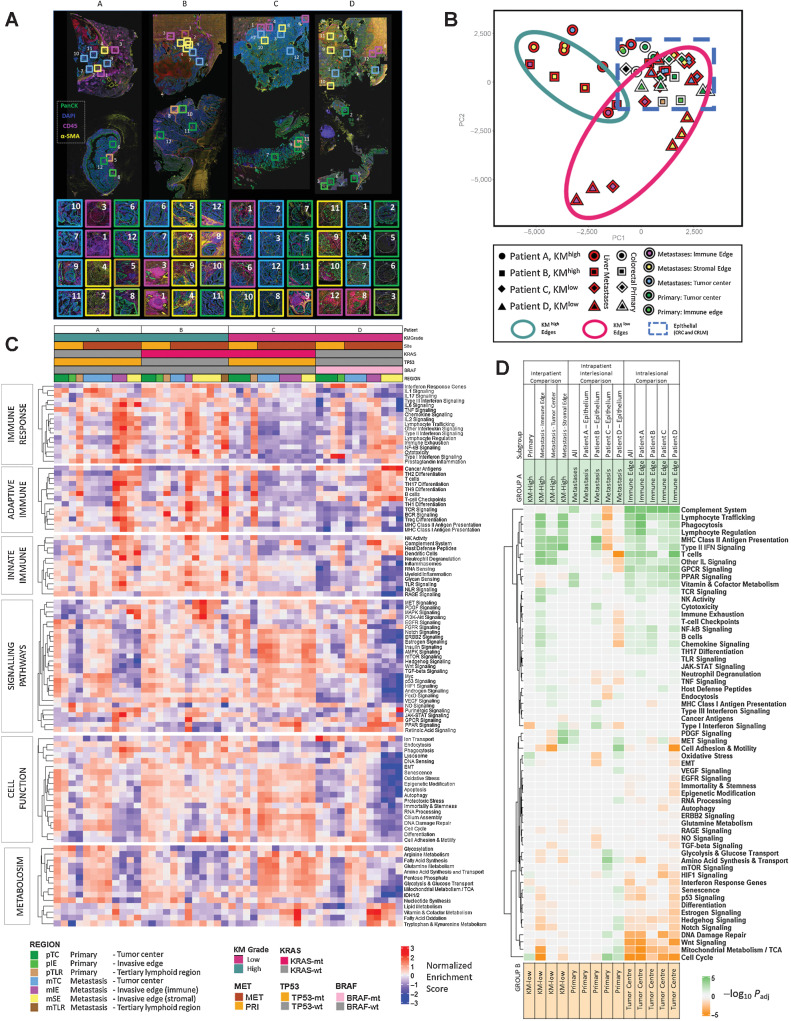 Figure 4. Spatially resolved transcriptomic analysis using Nanostring Cancer Transcriptome Atlas gene sets. A, Representative images of multiplex immunofluorescence (mIF) staining of 4 matched primary colorectal cancer and CRLM. DAPI (blue), Pancytokeratin (green), CD45 (pink), and a-SMA (yellow). Topographic regions are annotated, each box represents hand-selected area of tumor. 8 regions were taken from CRLM and 4 from primary colorectal cancer per patient. Patient A: KMhigh KRAS-wt, good prognosis. Patient B: KMhigh, KRAS-mt, good prognosis. Patient C: KMlow, KRAS/TP53 co-mutation, poor prognosis. Patient D: KM-low, KRAS-wt, BRAF-mt high-mutational burden lesion. B, Principal Component Analysis plot of all regions of interest (ROI) selected. The patient from whom the lesion originated is represented by shape. A red border indicates region arises from CRLM and white border represents primary colorectal cancer. The topographical region within the lesion is illustrated by the innermost color of the shape. KM high metastatic edges are represented by a green circle, KMlow metastatic edges are represented by a red circle and a dashed blue line represents epithelial regions of primary colorectal cancer and CRLM. C, Heatmap demonstrating single sample GSEA for every ROI, ordered on the x-axis by Patient and ROI. Key presented to aid patient identification. The y-axis represents annotated gene sets from Cancer Transcriptome Atlas ordered by and clustered within modules of Immune Response, Adaptive Immune, Innate Immune, Signaling Pathways. Cell Function, Metabolism. Each cell represents the Normalized Enrichment Score scaled by pathway. D, Heatmap demonstrating GSEA providing inter-patient comparison of selected areas between KMhigh and KMlow patients and intra-patient comparison between primary and metastatic sites and intralesional comparison between tumor center and immune edge. Subset of regions filtered before GSEA is demonstrated in Subgroup. Subsequent groups compared in GSEA identified as Groups A and B. Group A annotated at top of diagram and represented by green. Group B annotated at bottom of diagram and represented by orange. Cells of heatmap represent −log10(Padj) for comparison, cell is tinted green if pathway is upregulated in group A and orange if upregulated in group B.