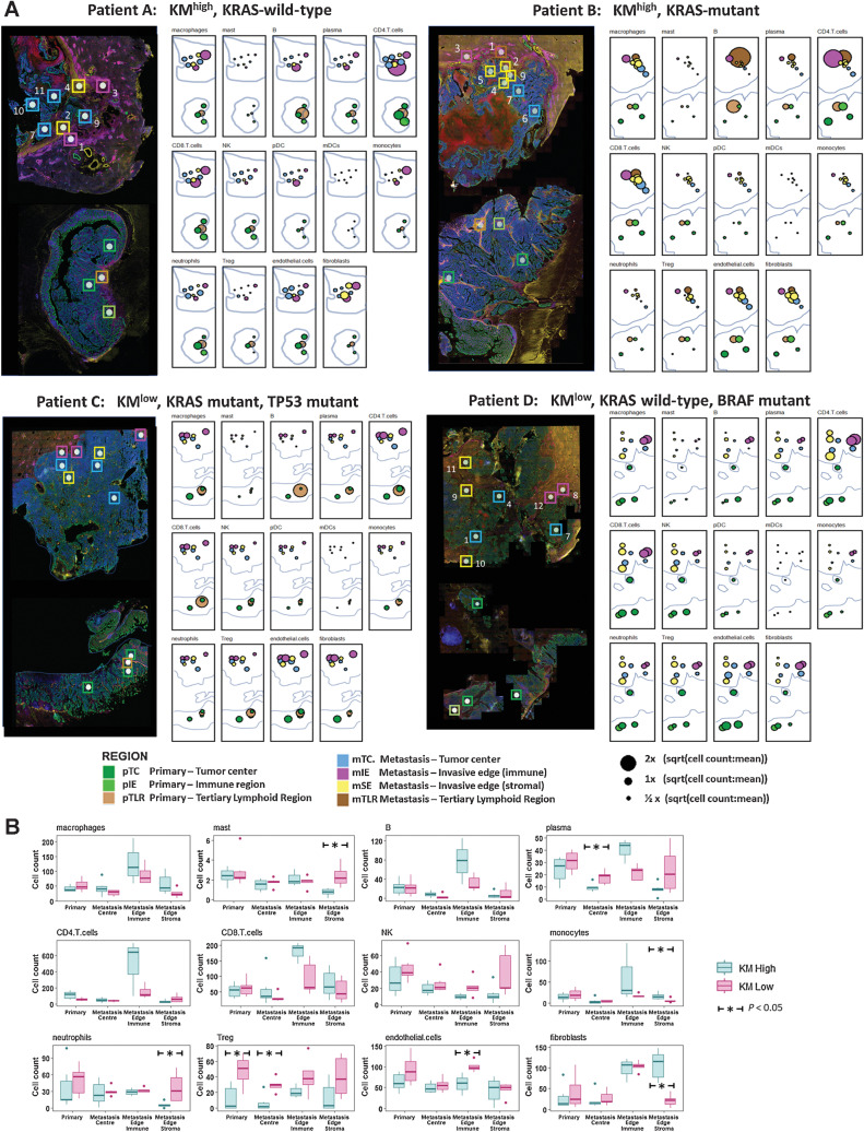 Figure 6. Topographic immune cell deconvolution primary colorectal cancer and CRLM. A, Images (from Fig. 4A) of primary colorectal cancer (bottom) and CRLM (top) with 48 ROIs superimposed. Abundance estimates as determined from transcriptome by SpatialDecon for 14 cell populations illustrated for each ROI with color-coding detailing the annotated tumor region. Radius is proportional to the estimated cell counts within the ROI. The immune cell count per region was extracted and the square root of the ratio to the mean immune cell count per region (41.37) of all immune cells was calculated and displayed. The square root of the ratio was calculated to minimize the skew caused by variance of highly expressed cell types. B, Box plots demonstrating the median and interquartile range for each cell type analyzed organized by cell type and topographic region and grouped by KM grade. All ROI taken from primary colorectal cancer except TLR are grouped as Primary. Dendritic cells were removed due to insignificant counts. The Mann–Whitney test used to assess for statistical significance; *, P < 0.05.