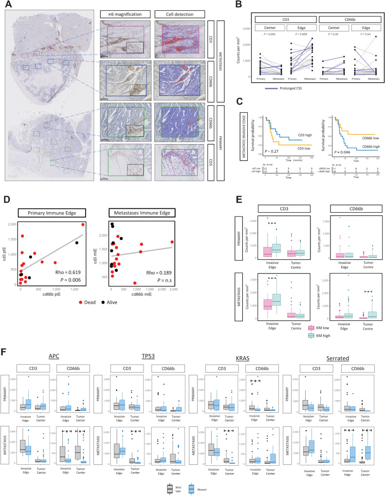 Figure 3. IHC characterization of matched primary colorectal cancer and CRLM with integration of morphological and mutational features. A, Representative images of CD3 and CD66b immunohistochemical staining (Patient B). Whole section demonstrated at ×0.5 magnifications, ROIs corresponding to tumor center (TC) and invasive edge (IE) of primary and CRLM shown at ×6 and ×10 (black box); scale bar, 100 μm. B, Intra-patient comparison between primary and metastasis of CD3 and CD66b cell counts at tumor center and invasive edge. P values calculated using the Mann–Whitney test. C, Kaplan–Meier survival plots (log-rank test, P values displayed) demonstrating the prognostic impact of CD3 and CD66b cell density at CRLM IE identified by IHC for IE of CRLM. High and low values determined according to median expression. D, Comparison of CD3 and CD66b cell density at (i) primary IE (ii) CRLM IE (iii) CD3 primary IE and metastatic TC. Spearman's Rho analysis. E, Box plots illustrating the relationship between KM grade and CD3 and CD66b cell counts at the IE and TC of primary colorectal cancer and CRLM. The P value was calculated using the Mann–Whitney test. F, Box-plot representing relationship between mutational features (APC, TP53, KRAS, Serrated) and CD3 and CD66b cell density at TC and IE of primary colorectal cancer and CRLM. The P value was calculated using the Mann–Whitney test. Lesions of serrated origin were defined as APCwild + KRAS/BRAFmutation.