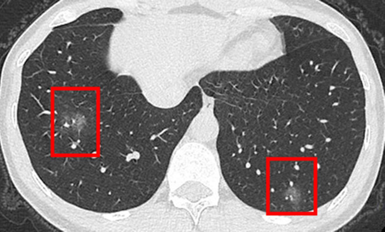 (a) Unenhanced CT image in a 43-year-old woman shows multiple ill-defined ground-glass opacities in the lateral segment of right lower lobe and the posterior segment of left lower lobe. (b) Unenhanced CT image in a 15-year-old male patient shows subtle nodular ground-glass opacities in the posterior segment of left lower lobe. (c) Unenhanced CT image in a 43-year-old man shows normal lungs.