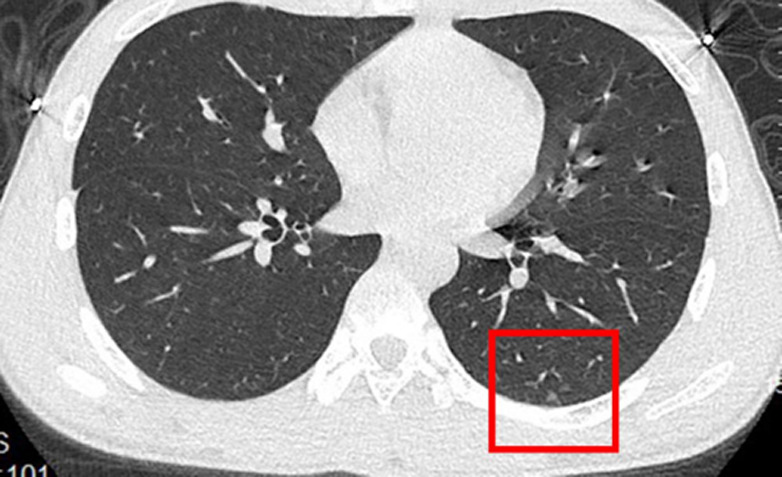 (a) Unenhanced CT image in a 43-year-old woman shows multiple ill-defined ground-glass opacities in the lateral segment of right lower lobe and the posterior segment of left lower lobe. (b) Unenhanced CT image in a 15-year-old male patient shows subtle nodular ground-glass opacities in the posterior segment of left lower lobe. (c) Unenhanced CT image in a 43-year-old man shows normal lungs.