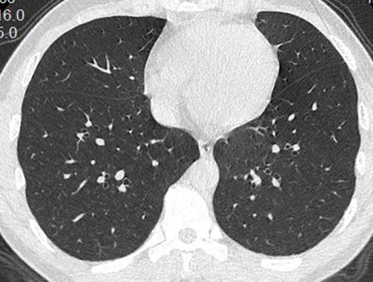 (a) Unenhanced CT image in a 43-year-old woman shows multiple ill-defined ground-glass opacities in the lateral segment of right lower lobe and the posterior segment of left lower lobe. (b) Unenhanced CT image in a 15-year-old male patient shows subtle nodular ground-glass opacities in the posterior segment of left lower lobe. (c) Unenhanced CT image in a 43-year-old man shows normal lungs.