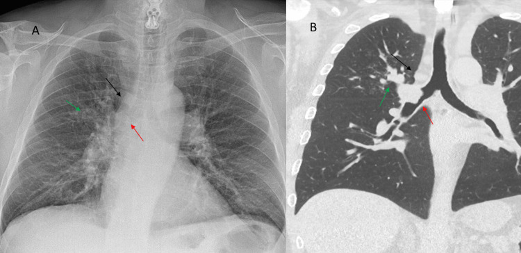 Lobar Mucus Plugging Reflecting Central Bronchial Tumoral Obstruction ...