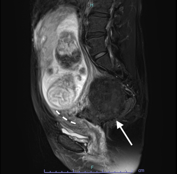 A case of incarcerated gravid uterus with a history of cesarean section ...