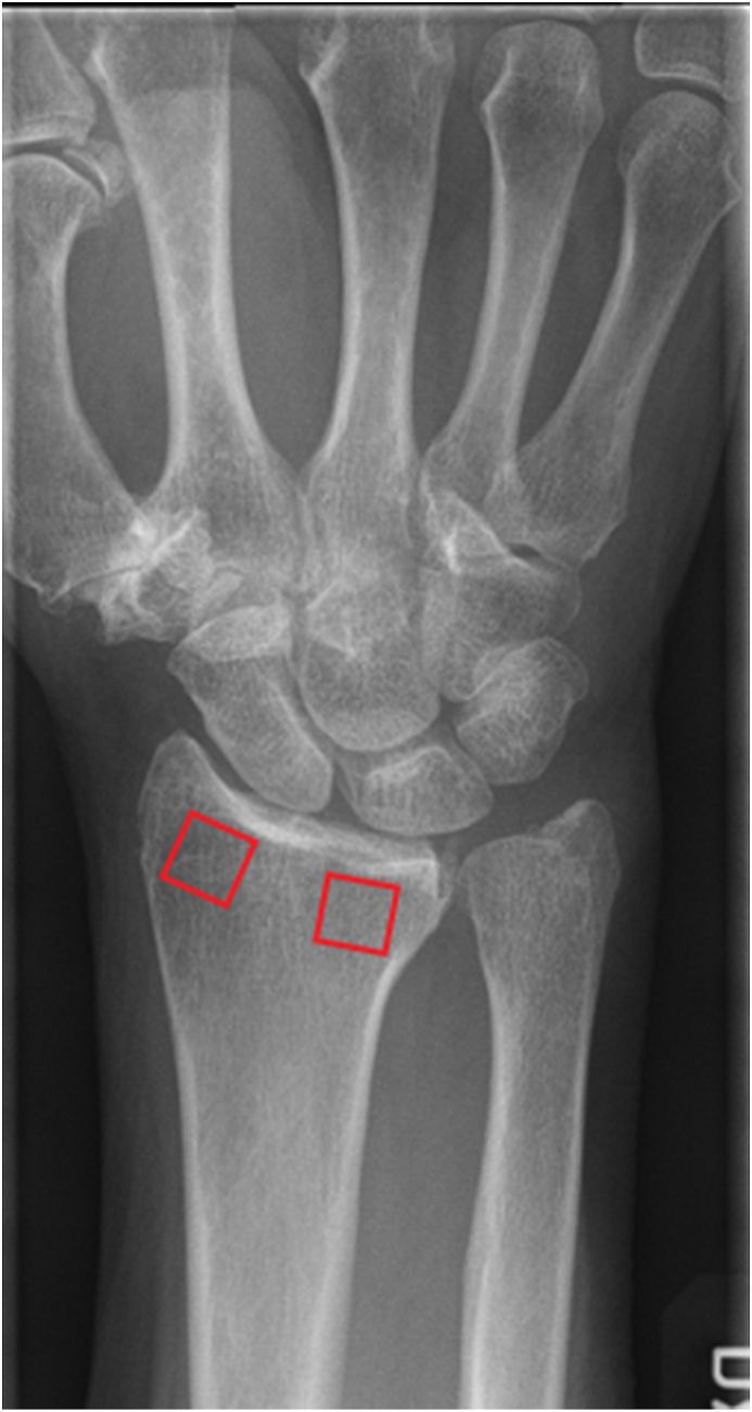 Assessment of a novel computer software in diagnosing radiocarpal ...