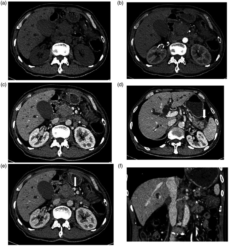 Pancreatic Metastasis From Squamous Cell Lung Cancer Computed