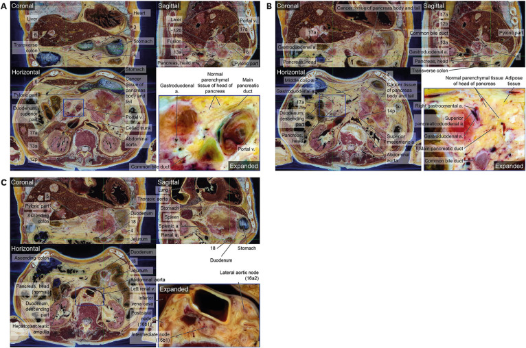 Lymph Node Stations of Pancreas Which Are Identified in Real Color ...