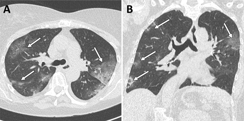 Example images from a 60-year-old female patient with clinical and CT findings suggestive of COVID-19 infection but repeated negative RT-PCR analysis. A, Axial and, B, coronal CT images show typical bilateral subpleural areas of ground-glass opacities. The patient was considered to be probably COVID-19 positive and quarantined. Note the incidental finding of moderate thoracic dextroscoliosis. Window center, −600 HU; window width, 1600 HU; slice thickness, 1 mm; and increment, 0.7 mm for all images.