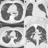 Example CT images in two patients with COVID-19. A, Axial and, B, coronal CT images in an 85-year-old woman presenting with dyspnea and fever for 3 days. CT images show typical early COVID-19 findings with bilateral subpleural areas of ground-glass opacities (arrows). Total CT involvement score was 7/25. Effective radiation dose was 0.52 mSv. C, Axial and, D, coronal CT images in a 41-year-old woman presenting with cough and fever for 14 days. CT images show typical late COVID-19 findings with multifocal bilateral subpleural areas of consolidation (arrows). Total CT involvement score was 15/25. Effective radiation dose was 0.53 mSv. Window center, −600 HU; window width, 1600 HU; slice thickness, 1 mm; and increment, 0.7 mm for all images.